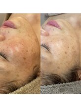 アンバー(amber)/しみのお悩みにも◎