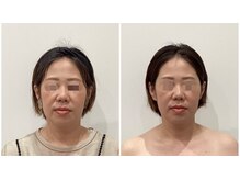 リシュレータ(RISYURE-TA)/美容鍼（before after）