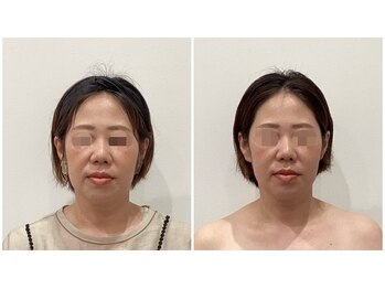 リシュレータ(RISYURE-TA)/美容鍼(before after)