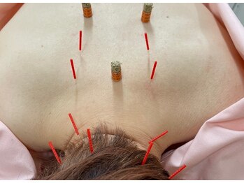けん鍼きゅう整骨院/【つらい肩こり】鍼灸