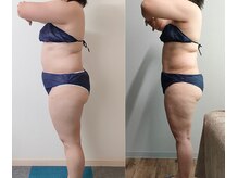 レモンボトル3回施術(30代)