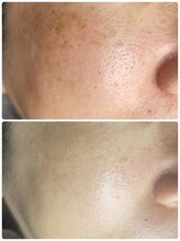 ティエラ(TIERRA)/シミケア