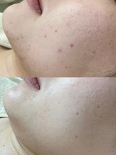 エムクレア(M.clair)/20代女性／にきび症例