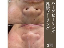 サロンドペシェ(salon de peche)/ハーブ２回・乳酸ピーリング１回