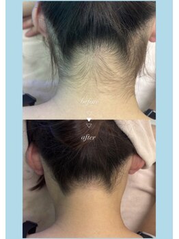 ローズ(Rose)の写真/初めての方、学生さんにもおすすめ！メンズにも効果実感◎痛みの少ない全身脱毛でつるすべ美肌へ♪