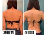 【ブライダルエステ】人生最高の姿に◇脂肪分解［二の腕・背中・顔］￥99000→