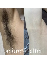 ベルカーラ(Belcarra)/メンズ脱毛