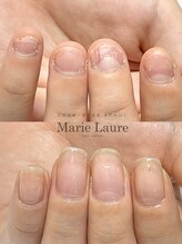 マリーロール 梅田店(Marie Laure)/自爪育成/深爪矯正/ネイルケア