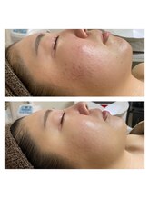 ホズリル(Hozril)/お肌改善！！