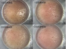 ドアディ(Doordie)/韓流毛穴洗浄スキンサクション