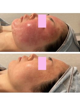 サロン ラズリ 久留米店(SALON Lazuli)/【イオン導入】赤ら顔