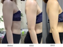 スラリ(SLARI)/【二の腕　脂肪冷却】