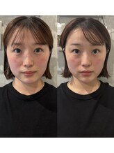 マホロバ(mahoroba)/美容鍼ビフォーアフター