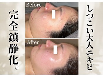 リリーシャ 赤坂(LILISHA)/赤みニキビを鎮静くすみ赤み改善