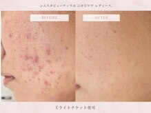 シエスタビューティラボ/【ニキビ改善コース】8回後
