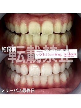 ホワイトニングサロン 福岡博多店/ホワイトニング