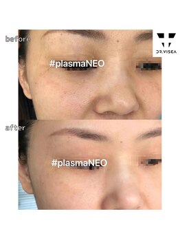 ルミラポー(Lumira Peau)/30代3回