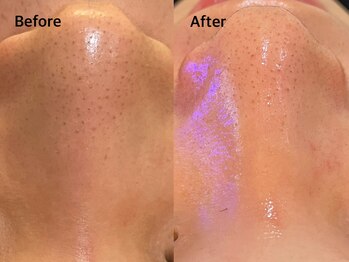 アンベリール(Embellir)/毛穴洗浄beforeafter