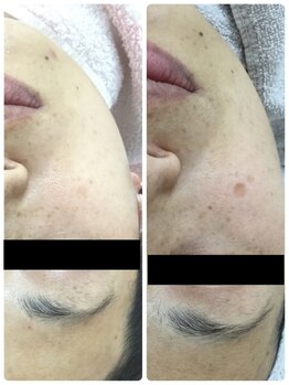 メイユール(MEILLEUR)/光フェイシャル18回