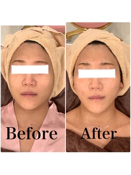 スペチアーレ 夙川/たるみ予防&法令線暖和に効果的