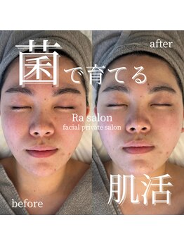 アールエーサロン 恵比寿 広尾(Ra salon)/美肌菌ピーリングbefore/after
