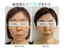 プルチャームエクイデム(Pulchram equidem)/ララピール+エレクロポーション