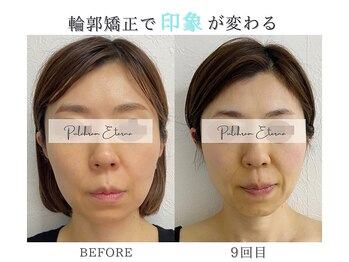 プルチャームエクイデム(Pulchram equidem)/ララピール+エレクロポーション