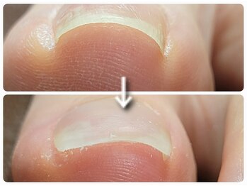 エーケーネイル(AKnail)/親指巻き爪補正