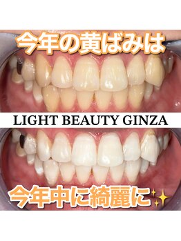 ライトビューティー 銀座店(LightBeauty)/東銀座 ホワイトニング 症例写真