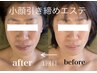 【小顔エステ】低周波によるたるみケア リフトアップ/¥8000