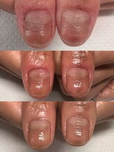 カンパニュラ(Campanula)/1日1回のオイル塗布で改善♪