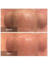 リジュベ(Rejuve)/毛穴エクストラクション[本八幡]