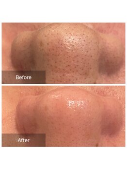 リジュベ(Rejuve)/毛穴エクストラクション[本八幡]