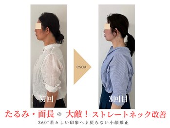 エソア(esoa)/40代 小顔矯正