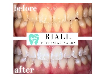 リアリ 宮崎(RIALI.)/プラチナホワイトニング