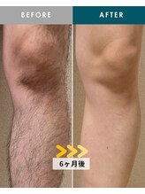 モモナ(Momona)/佐世保/脱毛/足脱毛/全身脱毛