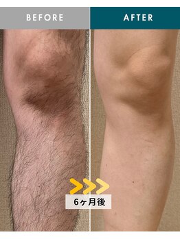 モモナ(Momona)/佐世保/脱毛/足脱毛/全身脱毛