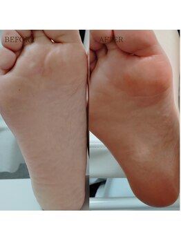 ケア付きフット磨き仕上げ