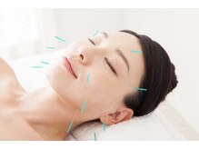 北千住整骨院/リフトアップ美容鍼