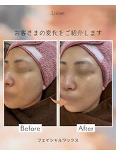 リシアン(Lisian)/フェイシャルワックスでタマゴ肌