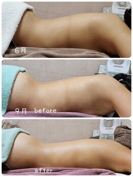 ソエルテ(Soelte)/サイズダウンへ導くリンパケア