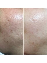 リブ(Lib)/光フェイシャルでエイジングケア