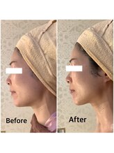 スペチアーレ 夙川/小顔★法令線暖和に