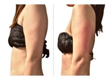 サロンドモフィ(salon de moffy)/痩身【脂肪冷却】二の腕 施術例7