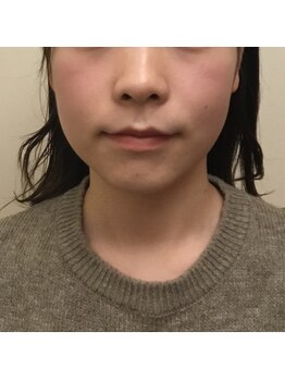 プリンセス バイ セイフティプリンセス 長野店(PRINCESS)/劇的！小顔矯正～Before～