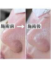 ニュートラル(neutral)/毛穴エクストラクションプロ大分