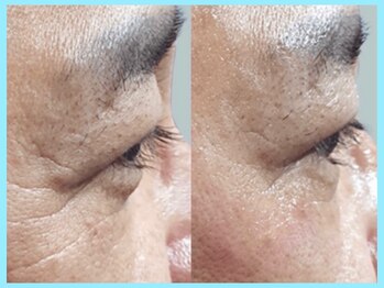 ハーブピーリング 名古屋/ララピール 導入★