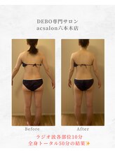 エーシーサロン 六本木店(acsalon)/お尻のたるみ、むくみ撃退♪