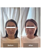 ルーム(ro-om)/リフトアップ・たるみケア＆艶肌