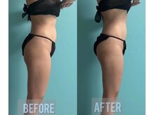 キノ(Kino)/セルライトゼロ★